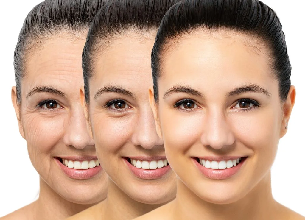 Facelift improves visible aging of the face and neck