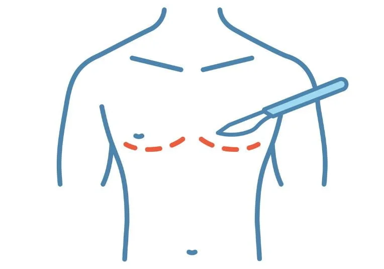 Objectives of gynecomastia surgery shown on image