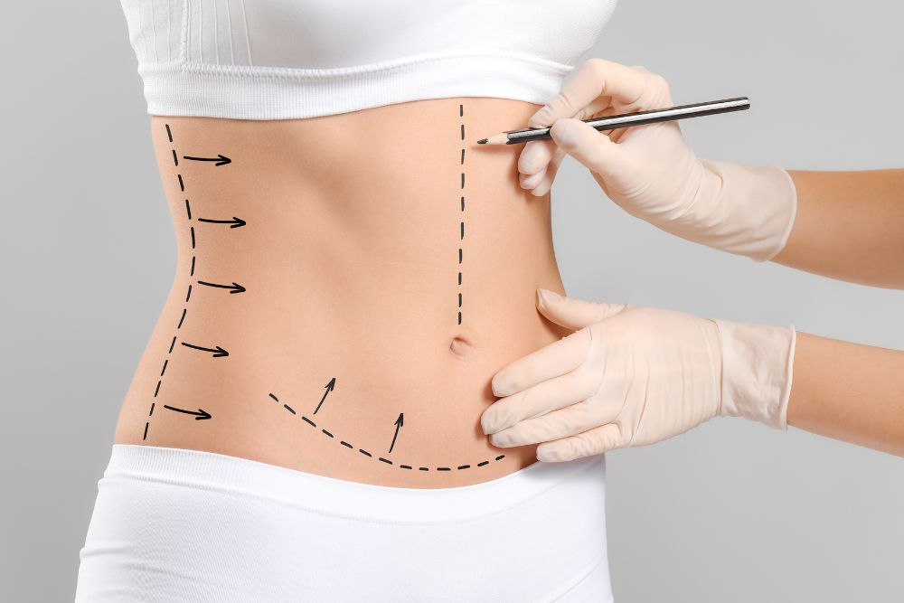 Liposuction procedure at Plastic Surgery Montreal