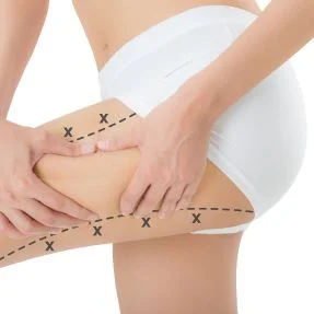 thigh lift markings